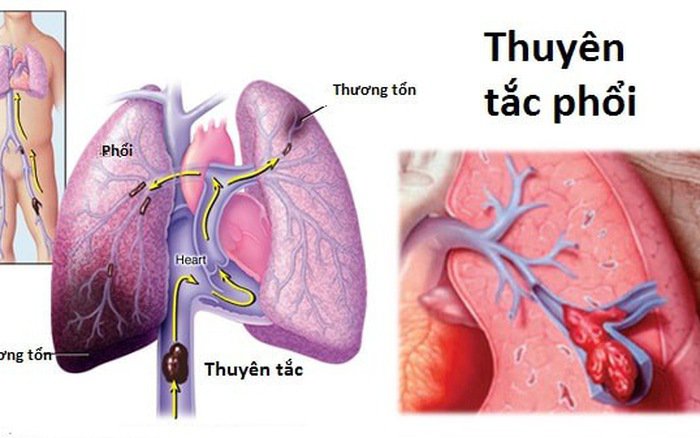 Đối tượng dễ mắc thuyên tắc phổi